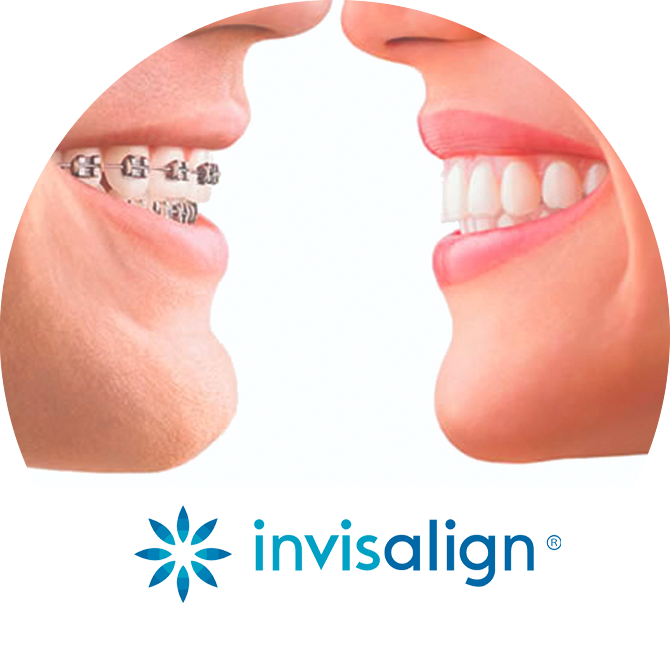 invisalign braces in studio city