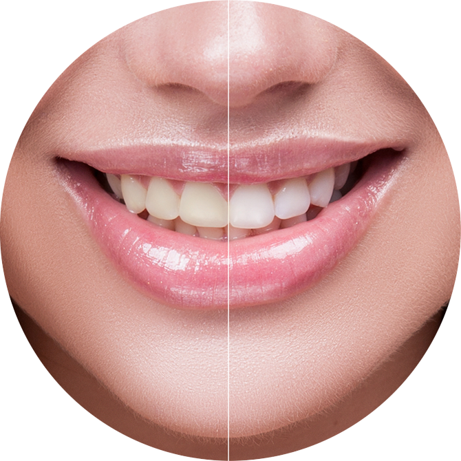 Zoom Whitening in Studio City