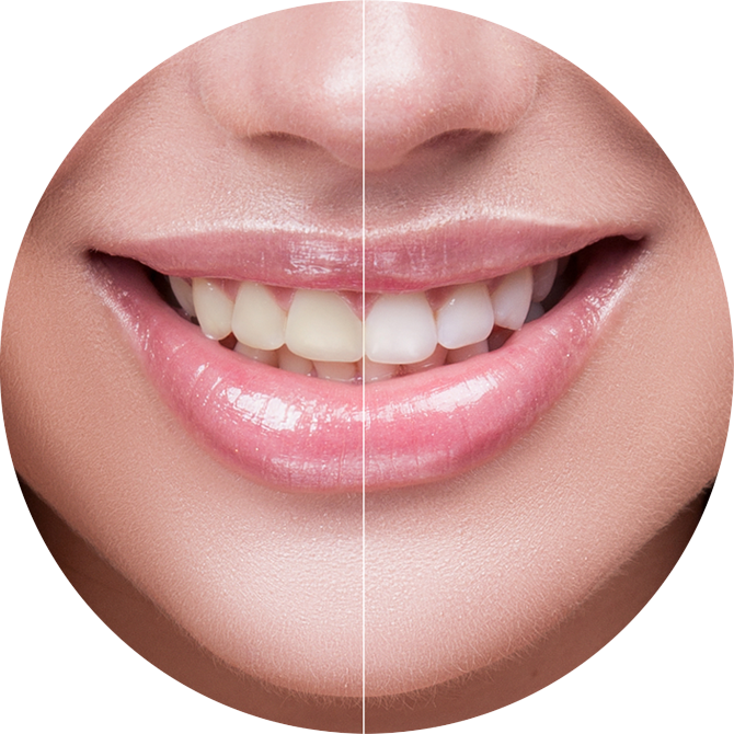 before and after tooth whitening in studio city